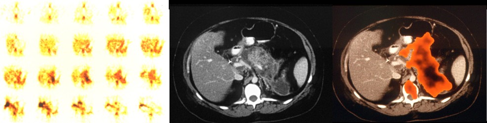 Gallium Pancreatitis with abscess comp