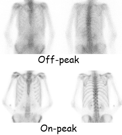 Off peak  off peak bone scan