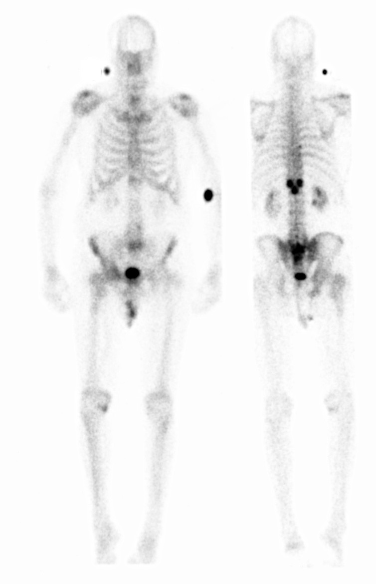 Skeletal Scintigraphy | Clinical Nuclear Medicine